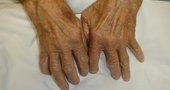 Ejercicios para mejorar la artritis
