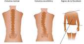 Síntomas y tratamiento de la escoliosis lumbar Síntomas y tratamiento de la escoliosis lumbar