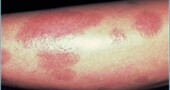 La psoriasis aumenta el riesgo de sufrir un ictus cerebral La psoriasis aumenta el riesgo de sufrir un ictus cerebral