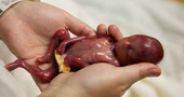 Bebé prematuro de 19 semanas, que consiguió vivir unos minutos, conmueve a millones de personas