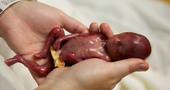 Bebé prematuro de 19 semanas, que consiguió vivir unos minutos, conmueve a millones de personas Bebé prematuro de 19 semanas, que consiguió vivir unos minutos, conmueve a millones de personas