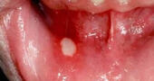 Tratamiento casero para las heridas en la boca