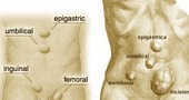 Que es una hernia Que es una hernia