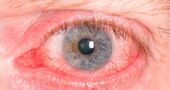 Ojos rojos Ojos rojos
