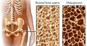 Qué es la Osteoporosis y cuales son sus síntomas Qué es la Osteoporosis y cuales son sus síntomas