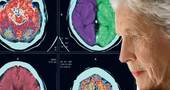Habilidad de montar bicicleta ayuda a diagnosticar Parkinson Habilidad de montar bicicleta ayuda a diagnosticar Parkinson