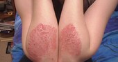 La psoriasis crece junto con el estrés La psoriasis crece junto con el estrés
