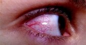 Remedios ojos rojos
