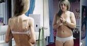 Síntomas de la anorexia Síntomas de la anorexia
