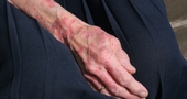 Tratamiento para la dermatitis Tratamiento para la dermatitis