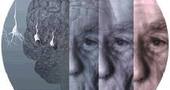Nueva vacuna contra el alzheimer Nueva vacuna contra el alzheimer